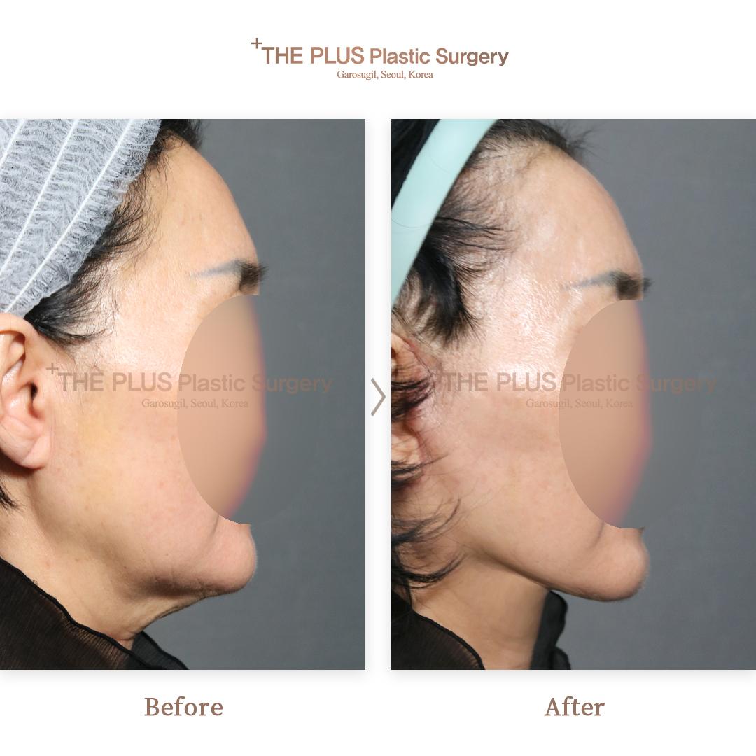 Face contouring + Mini Face Lifting + Forehead Lifting + Thread Lifting + Double Chin Tightening