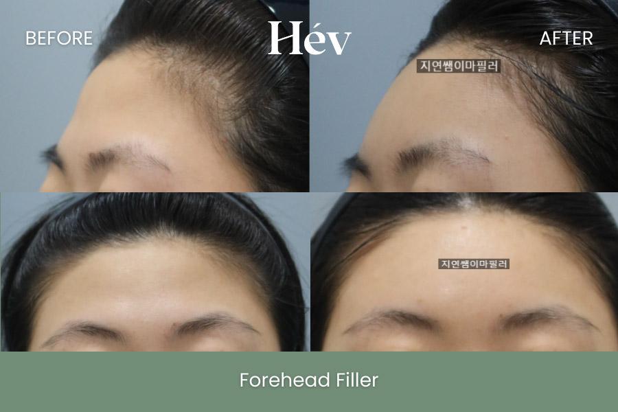 Forehead Filler