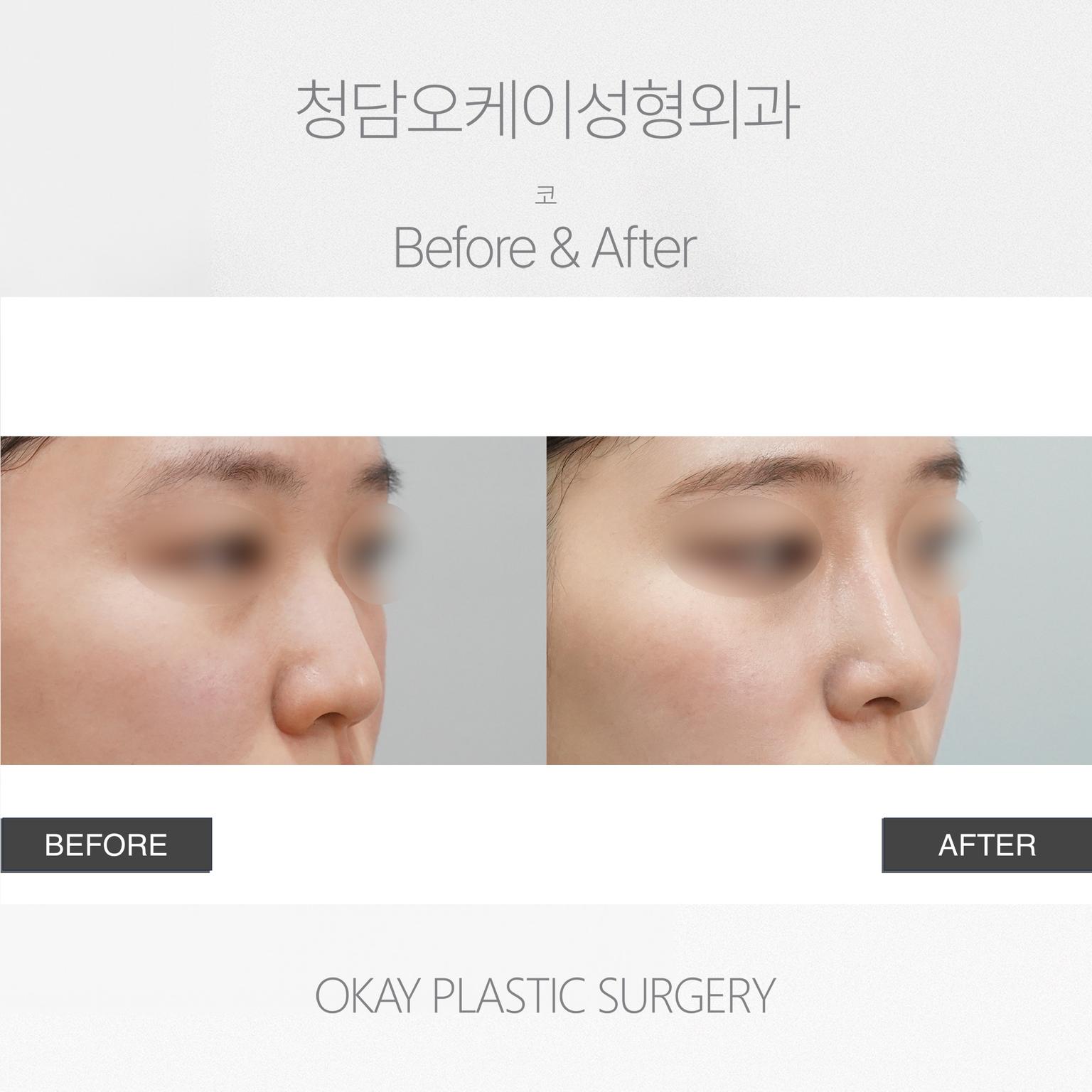 Okay Plastic Surgery Clinic before and after image