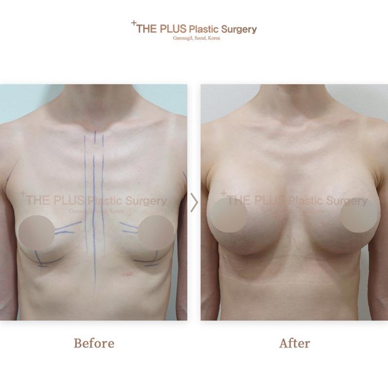 Breast Implant