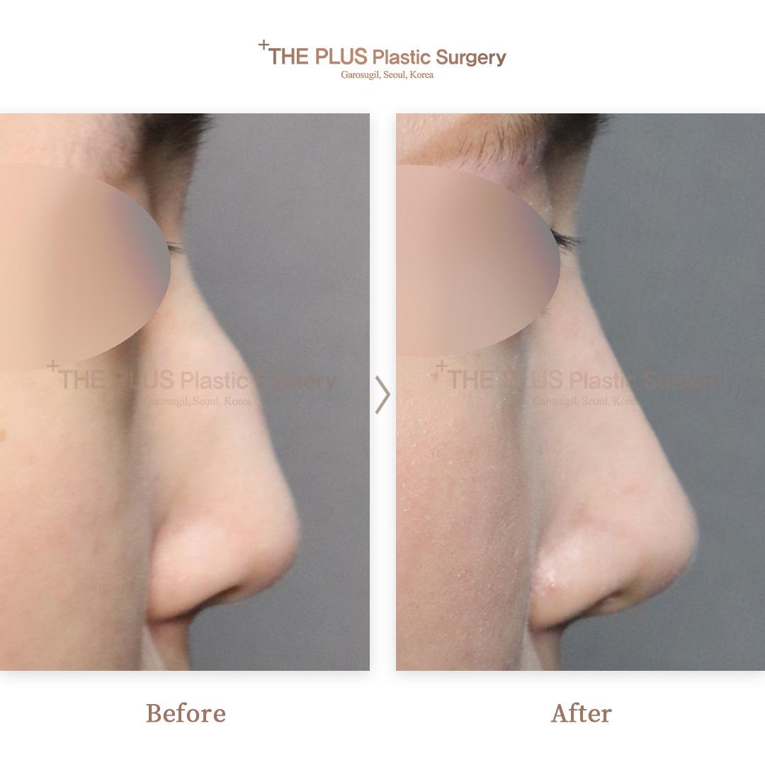 Primary Rhinoplasty & No Silicone & Nasal Tip Plasty & Nose Tip Correction & Ear Cartilage & Nose Osteotomy