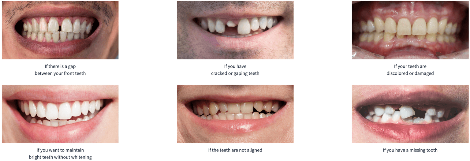 Veneers, All-ceramic Veneers