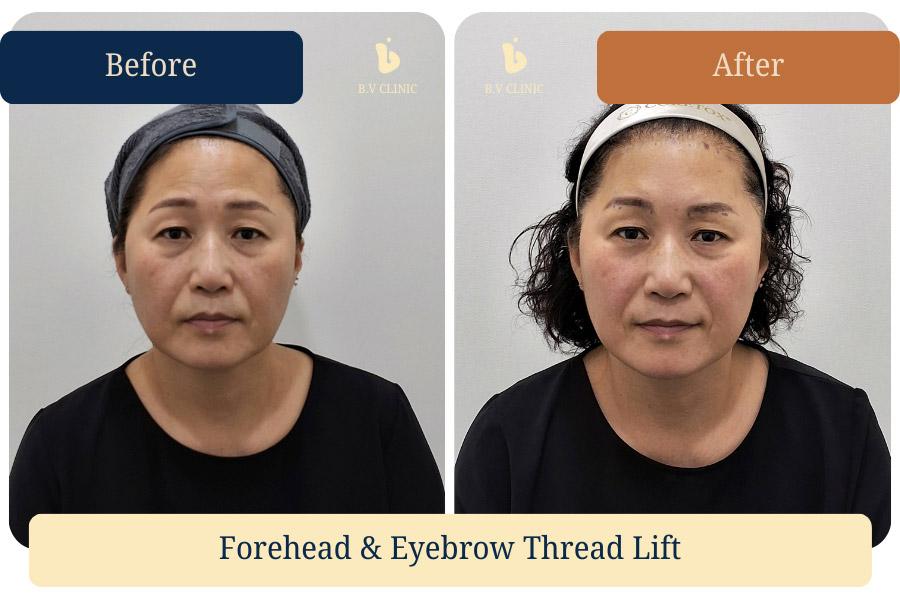 Forehead (eyebrow) thread lifting. Before and after photos taken on the day of the procedure. The patient requested stronger lifting on the right eyebrow due to pre-existing asymmetry.