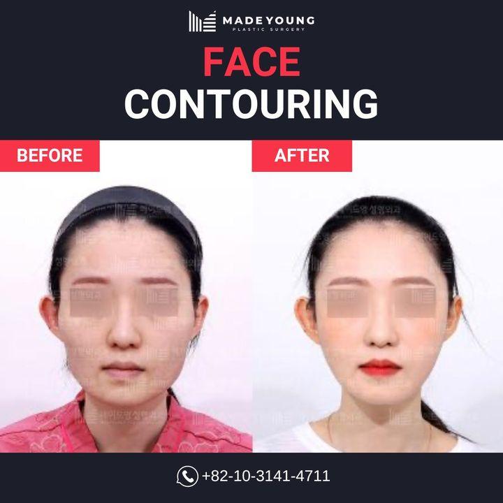 face contouring korea