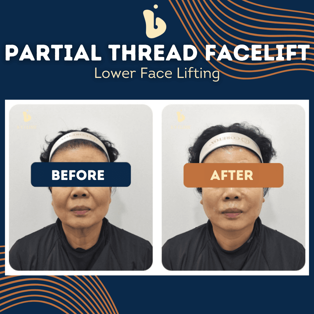 B.V Clinic before and after image