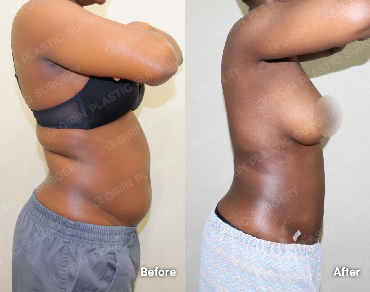 Before and After Abdominal Liposuction