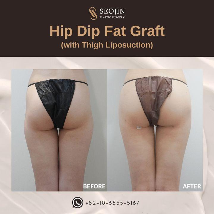 hip dip fat grafting
Achieve a smoother silhouette with our hip dip fat graft combined with thigh liposuction.