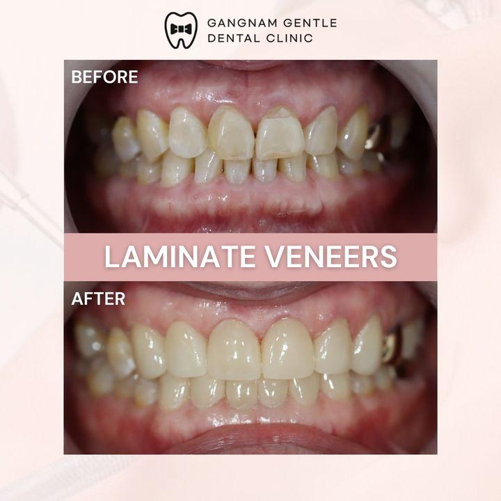 Each smile tells a story. With laminate veneers, your story can be about transformation and confidence. Check out our before and after results. #VeneersJourney #GangnamGentleDental