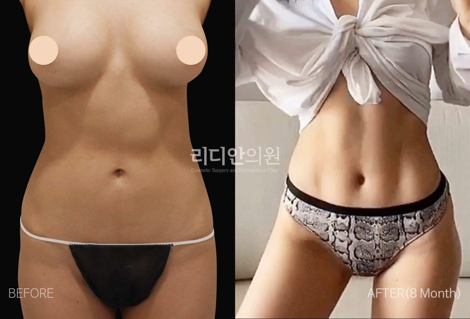 5d liposculpture korea
