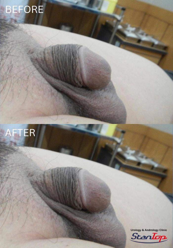 Penis Enlargement