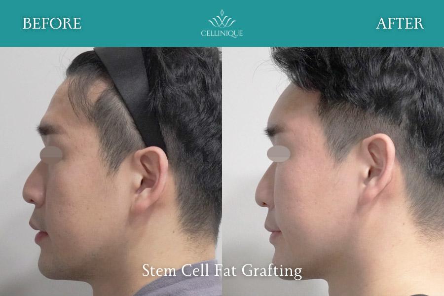 Before and After Stem Cell Fat Grafting