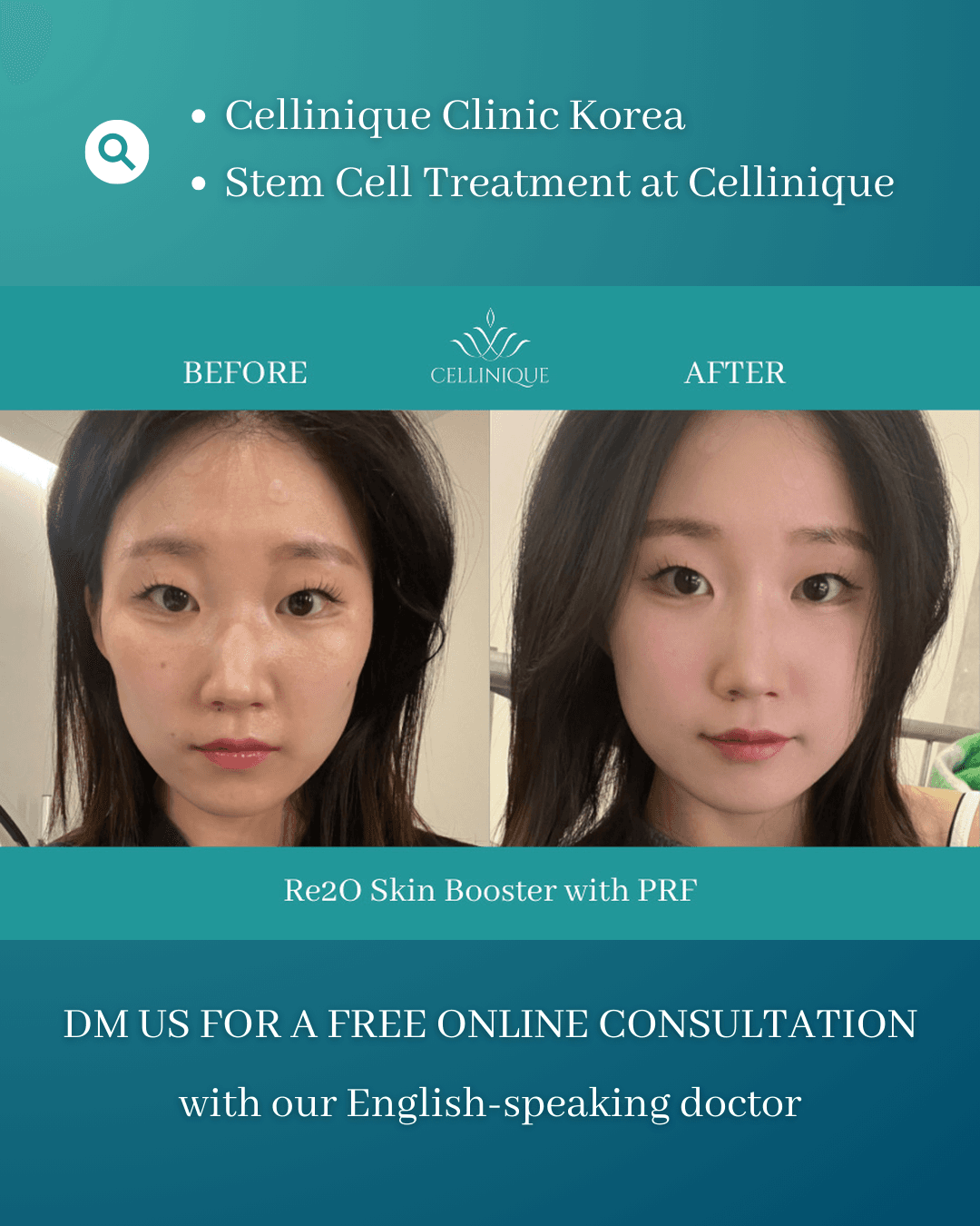 Re2O Skin Booster, PRF-Injektion, Skin Booster