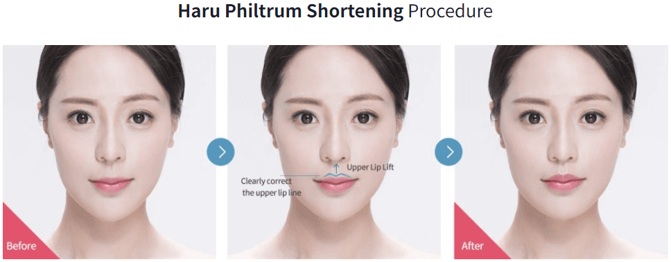 Bullhorn-Lip-Lift