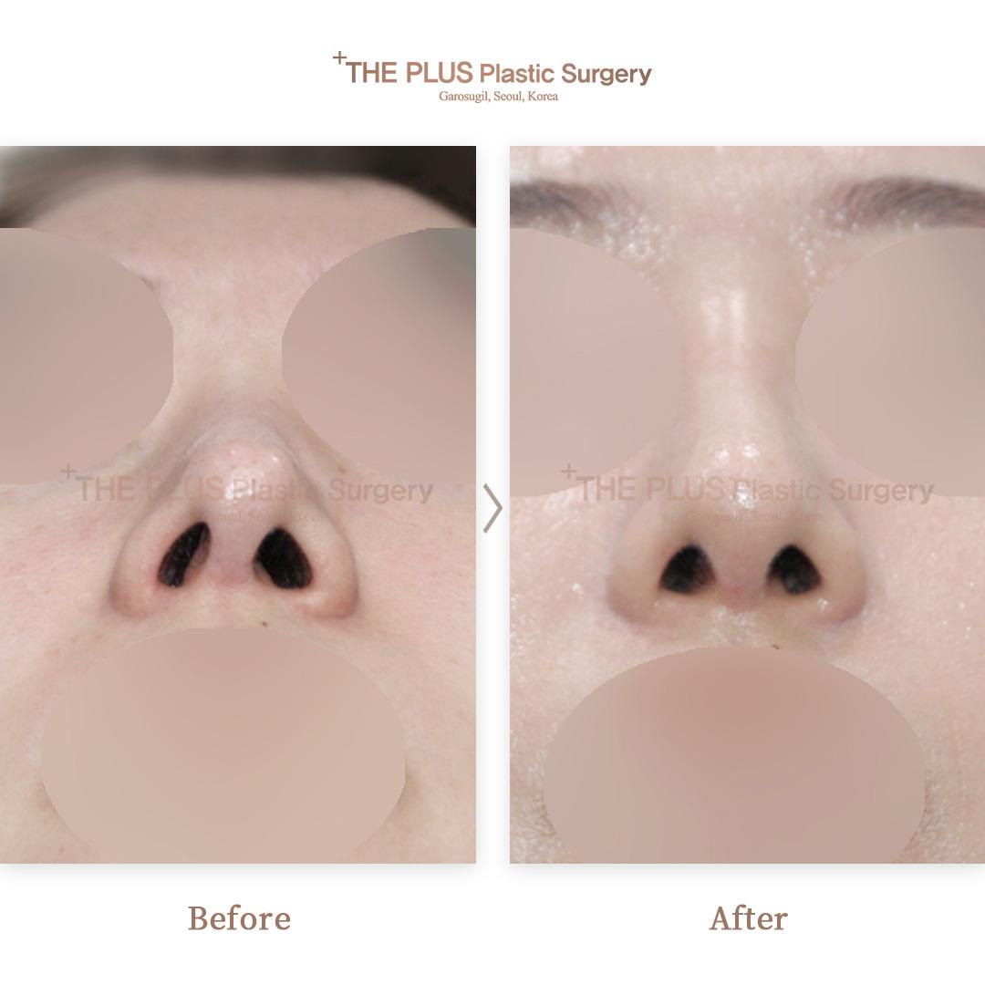 2nd Revision Rhinoplasty & Shortening & Columella Correction & Nose Osteotomy & Nasal Septum Deviation & Sinus Surgery & Ear Cartilage