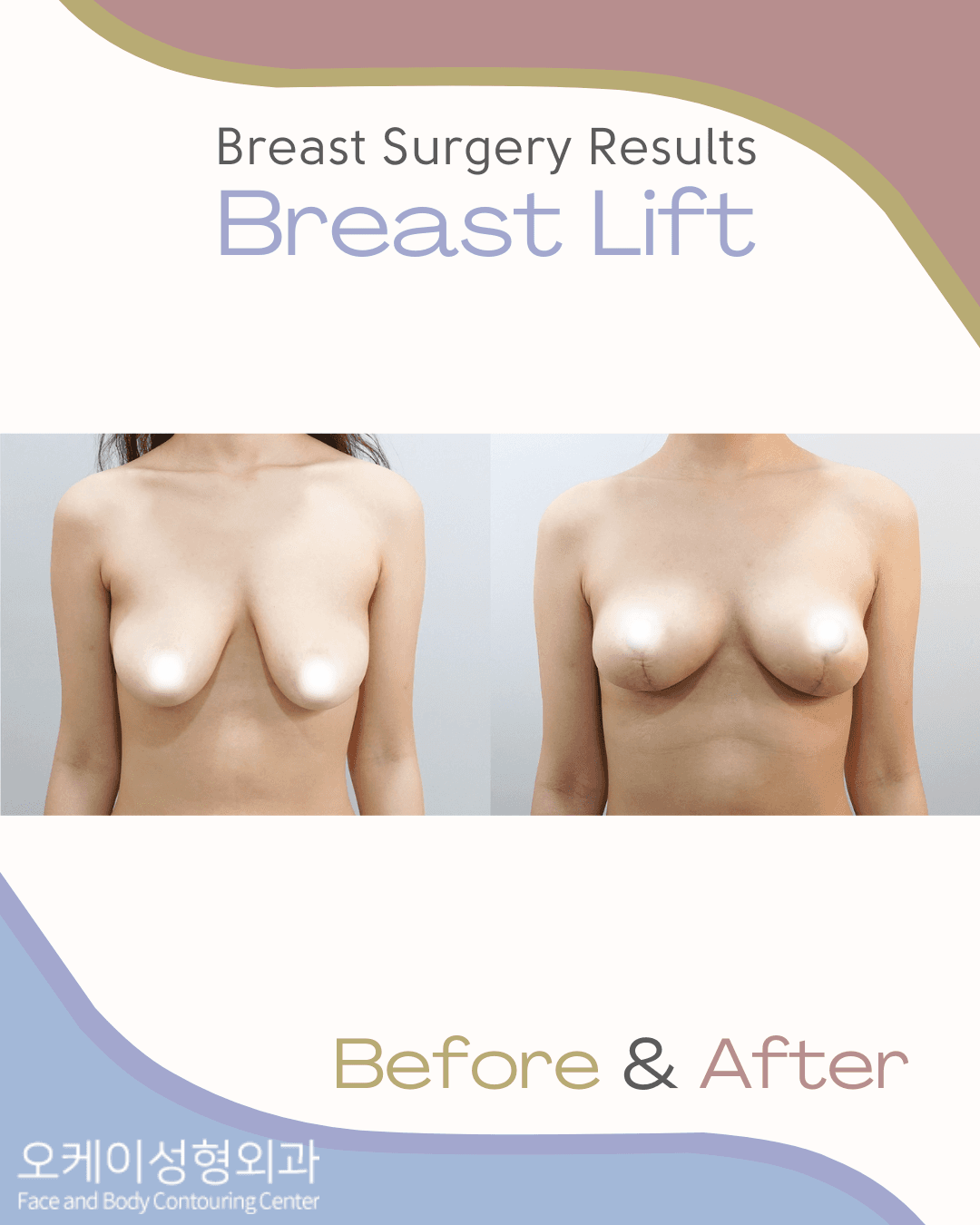 cost breast lift korea