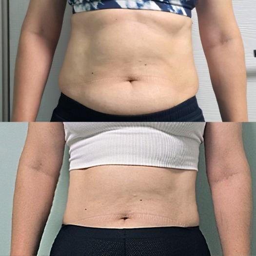Before and After Fat Dissolving Injection
