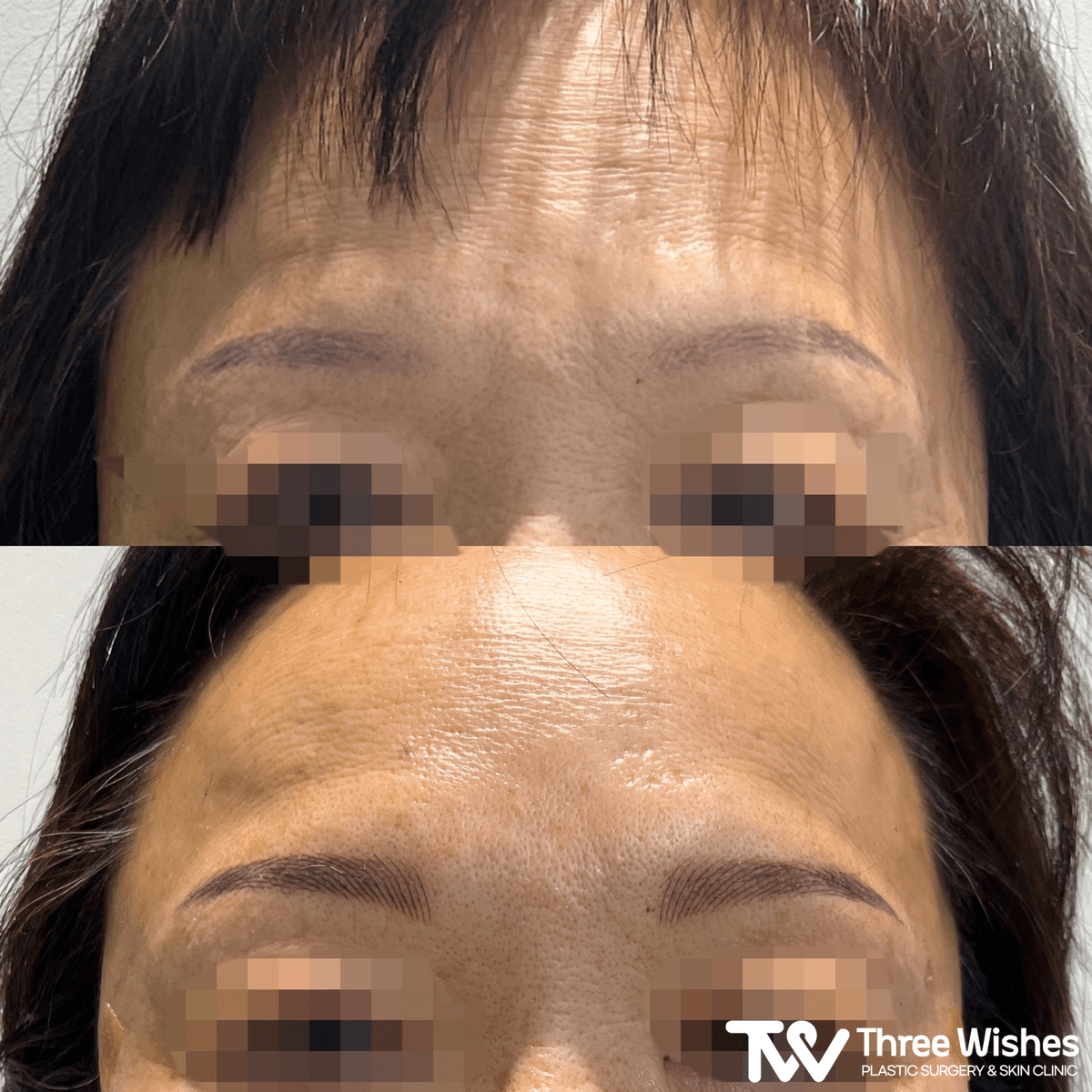 Before and After Volnewmer Laser Lifting