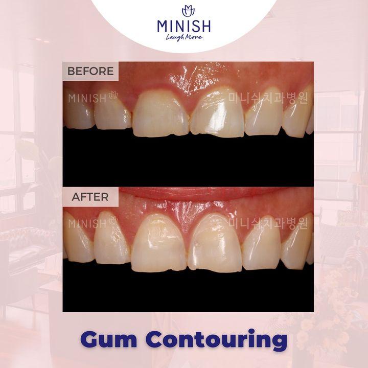 Transforming smiles, one contour at a time. Witness the precision of Minish gum contouring. #MinishMakeover