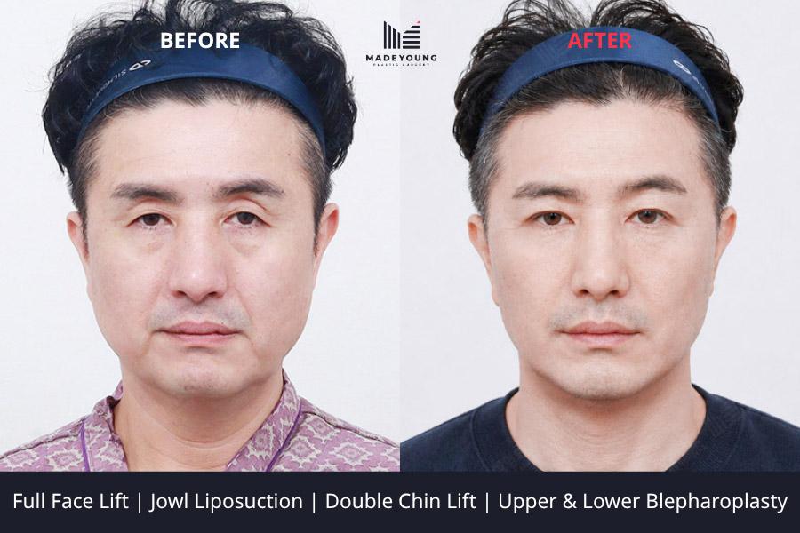 Before and After Face Lift