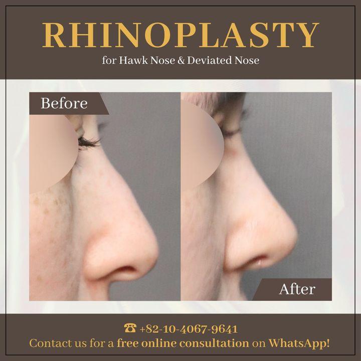 Achieve a balanced and harmonious facial structure with expert rhinoplasty. View the life-changing results in our before and after.