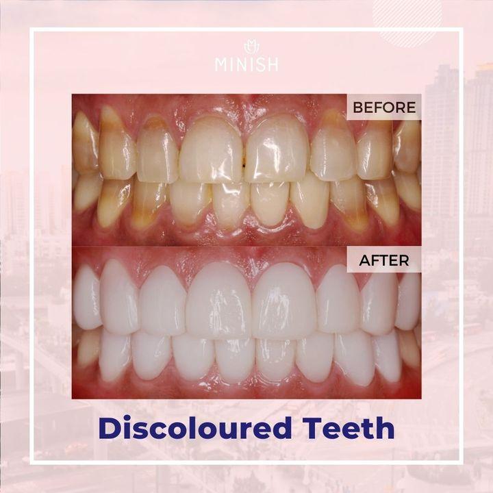 Don't Let Tooth Discoloration Hold You Back – Minish Veneers to the Rescue!