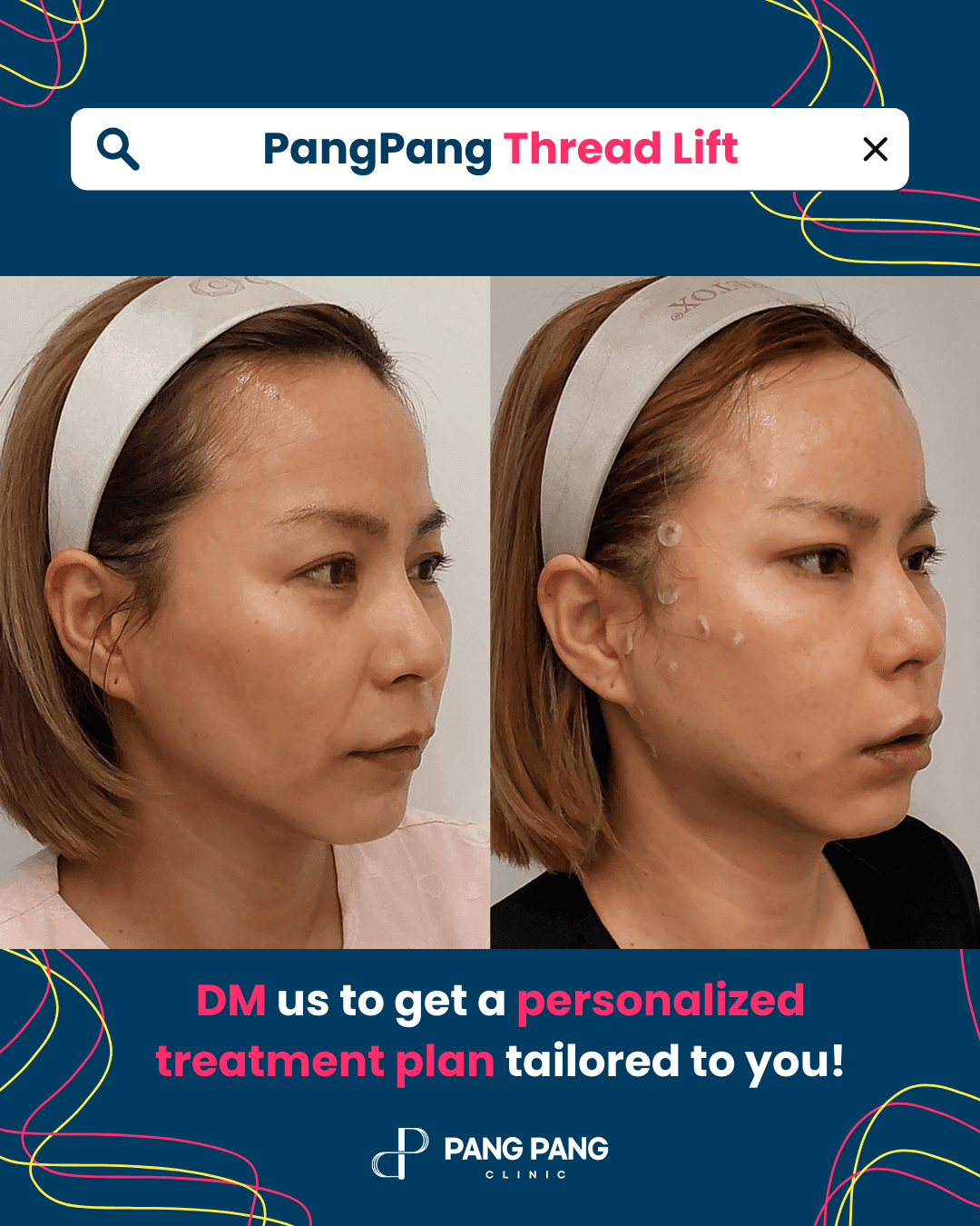 Thread Lift, Eyebrow Thread Lift, Forehead Thread Lift