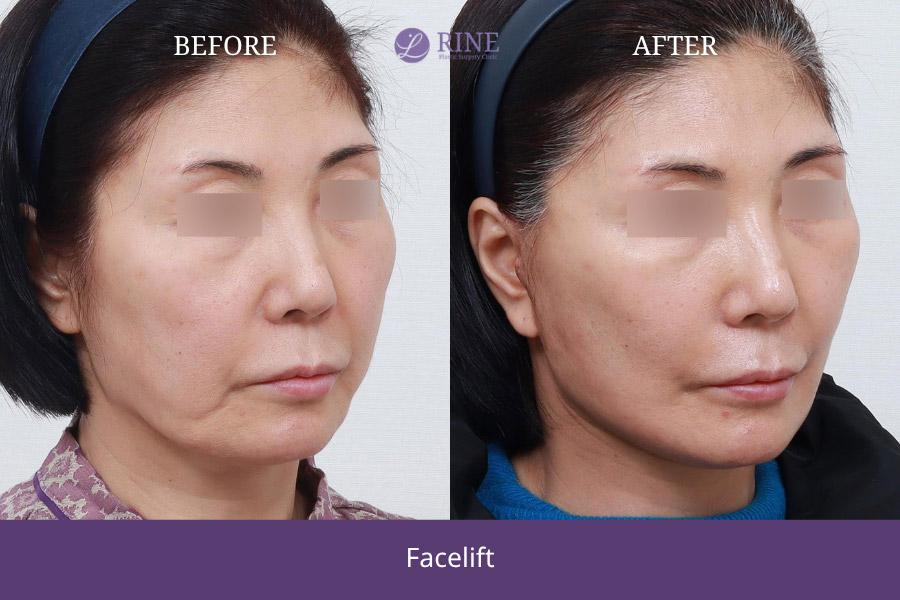 SMAS Facelift