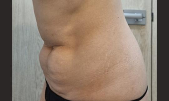 After Tummy Tuck