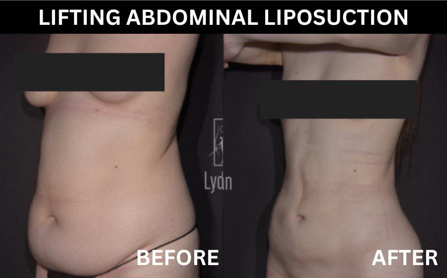 Lydian Plastic Surgery Clinic before and after image