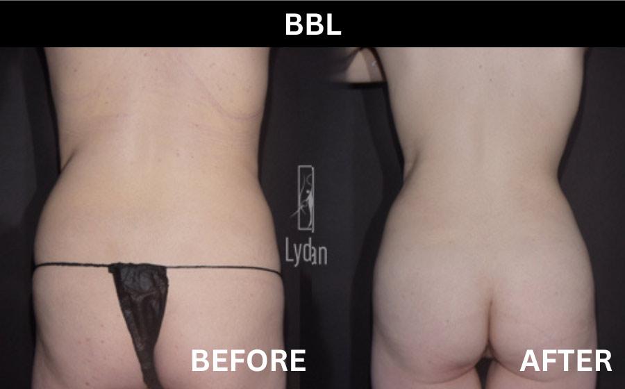 Lydian Plastic Surgery Clinic before and after image