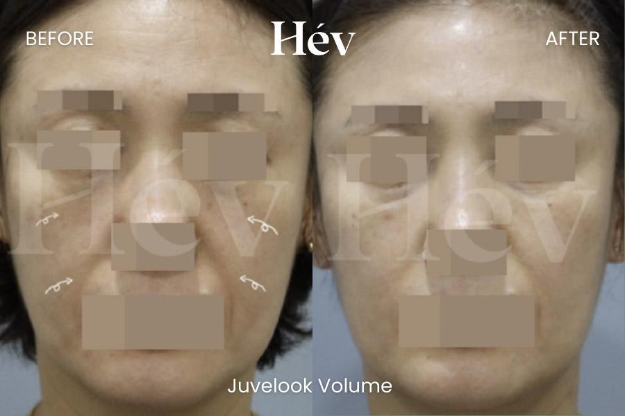 Juvelook Volume Smile Line Cheek Filler