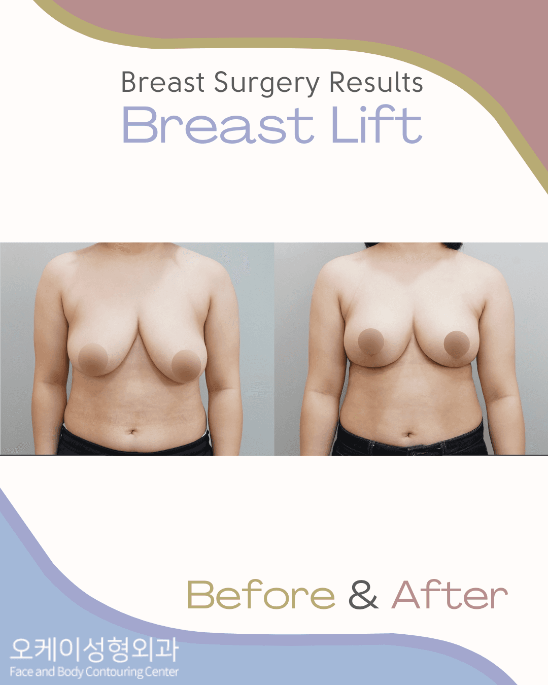 breast lift korea