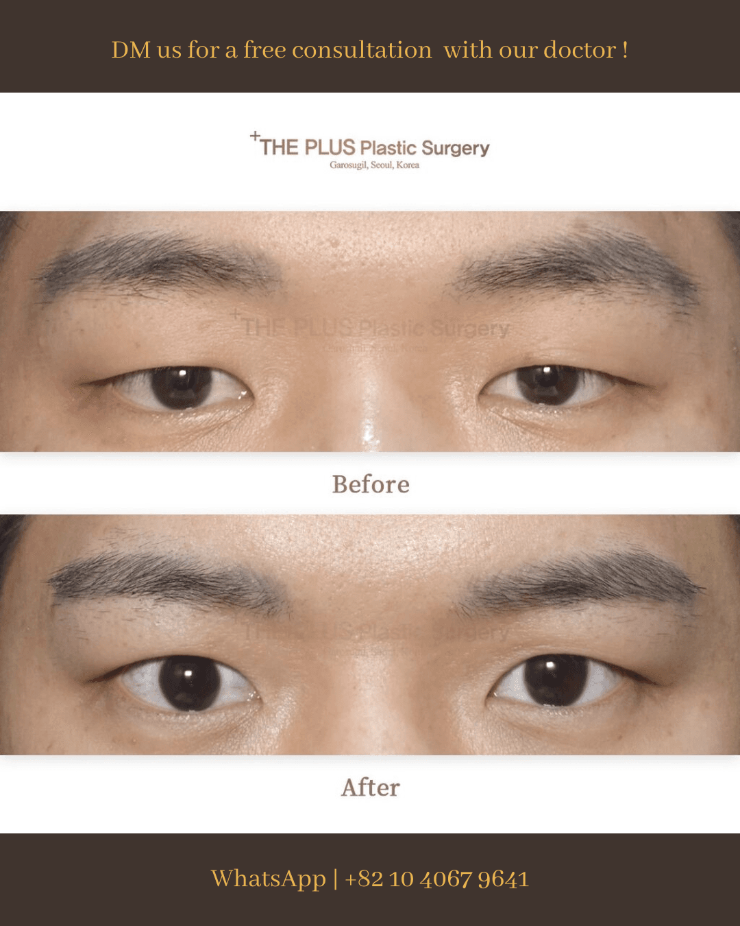 Ptosis Correction