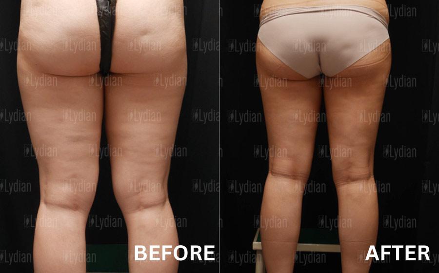 Lydian Plastic Surgery Clinic before and after image