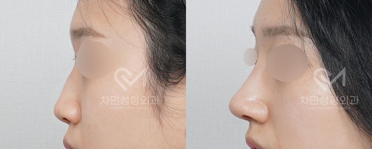 Before and After Rhinoplasty