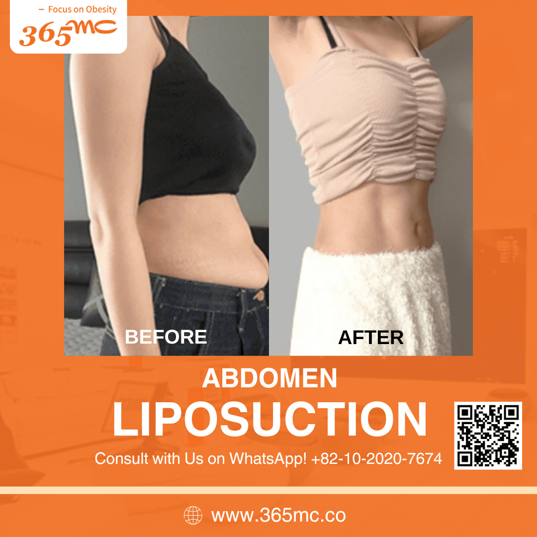 bna-abdomen-lipo.png