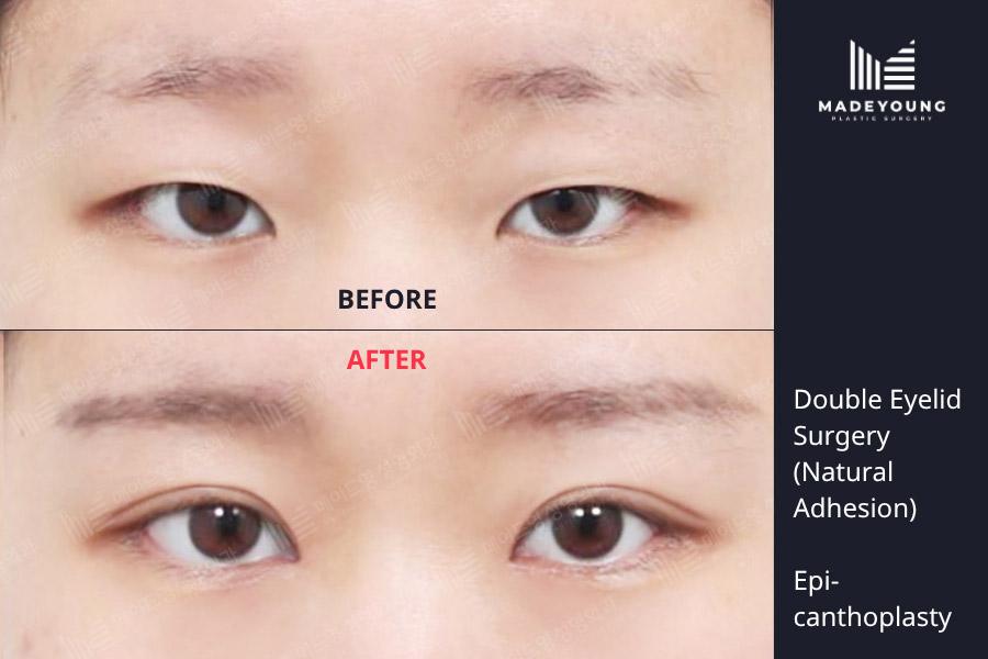 Eyelid surgery natural adhesion epicanthoplasty