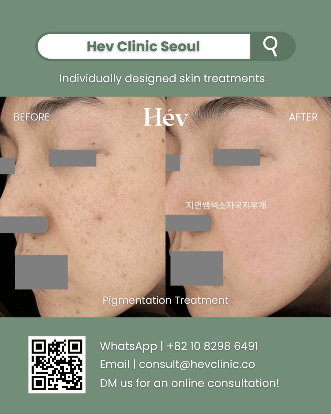 Pigmentation Treatment