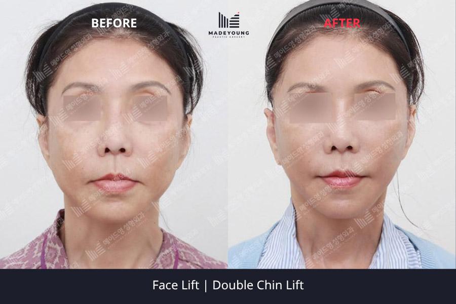 Made Young Plastic Surgery before and after image