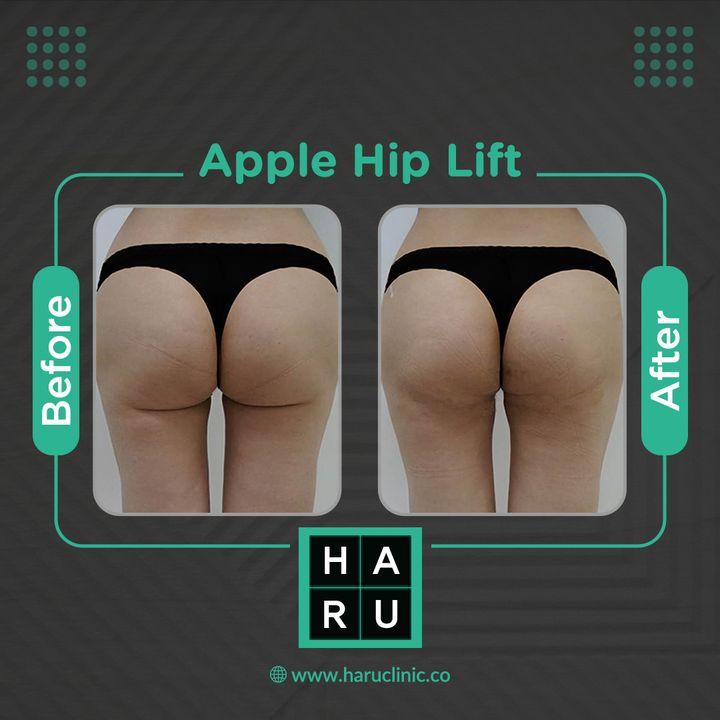 The “Haru Apple Hip Lifting” is a procedure designed to enhance the buttocks line without requiring a lengthy recovery period. This is achieved by using a special semi-permanent thread to create volume and a beautiful line.   To make more presentable to others take treatment from Haru on Apple hip lifting.  🏥