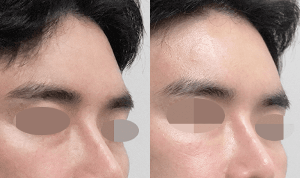 cellreand-female-stem-cell-fat-grafting-forehead-01.png