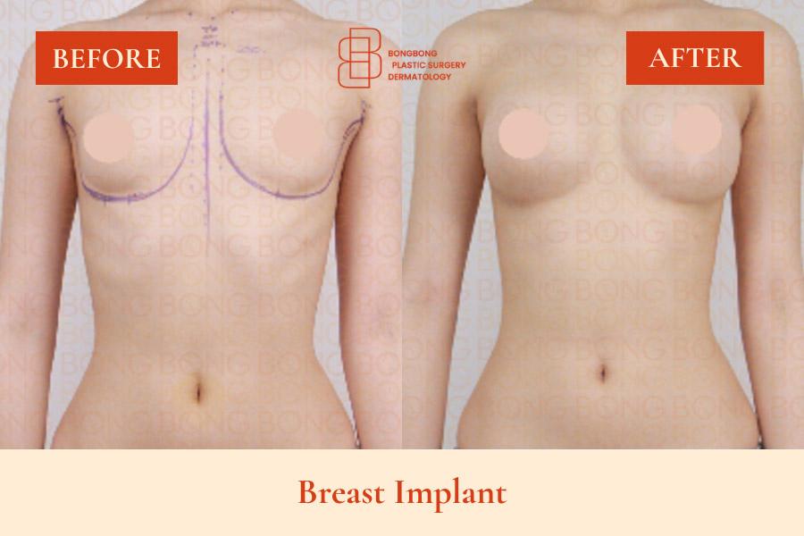 Before and After Breast Augmentation
