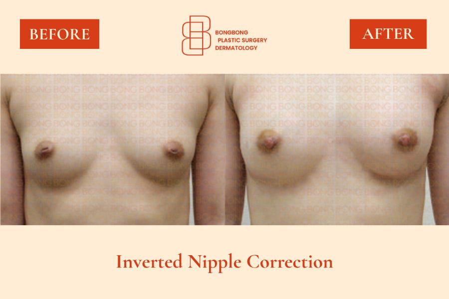 Before and After Nipple Surgery