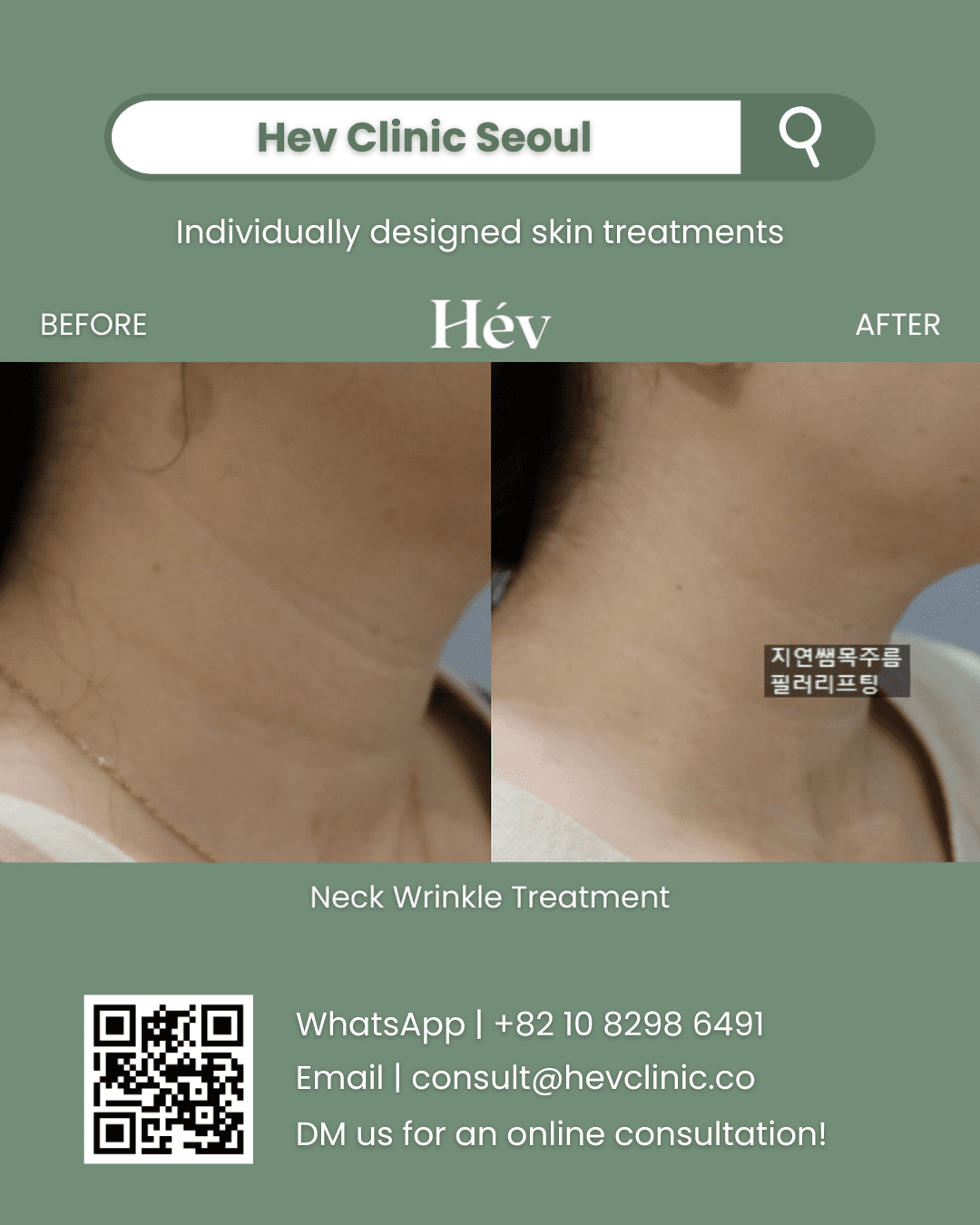 Neck Wrinkle Treatment