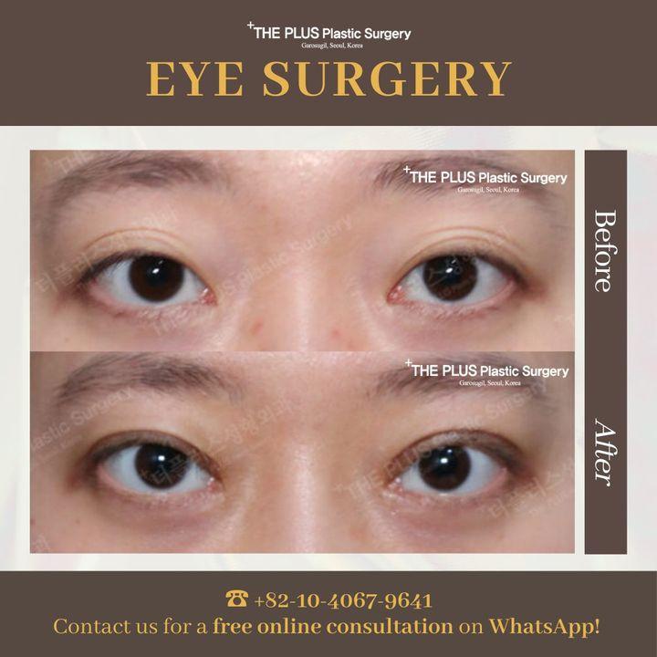 address epicanthal folds korea