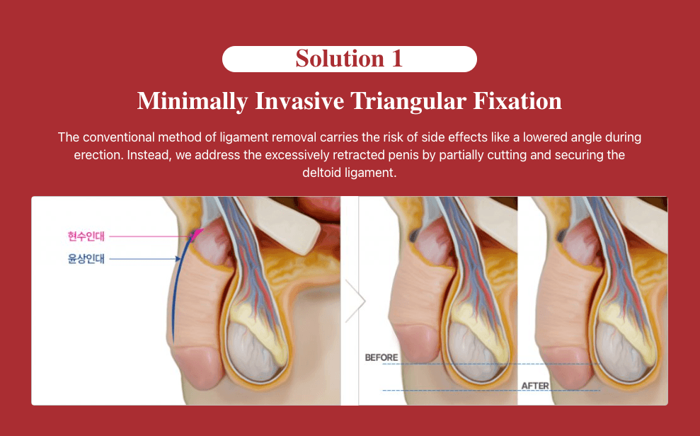 Penis Lengthening
