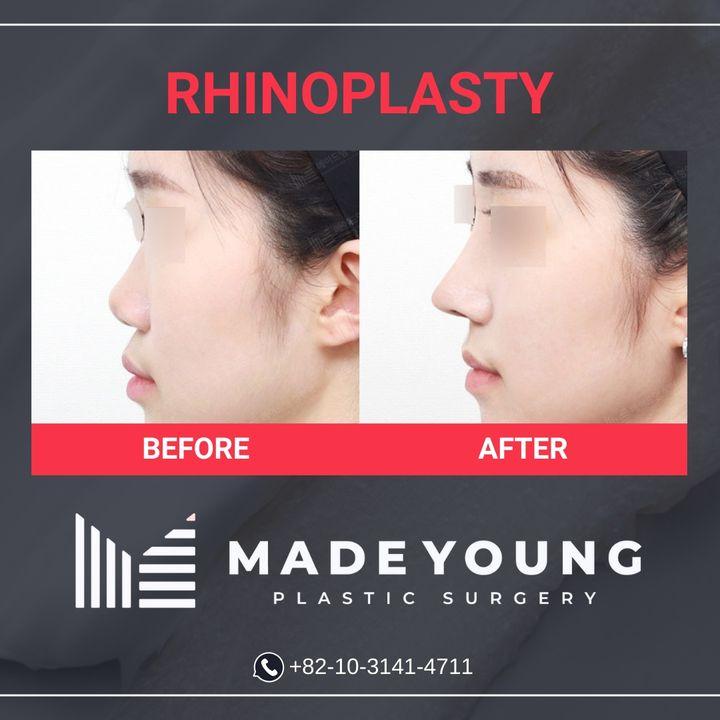 Rhinoplasty at MadeYoung: Where artistry meets precision. Each procedure is a step towards the balance and symmetry that complements your natural beauty.