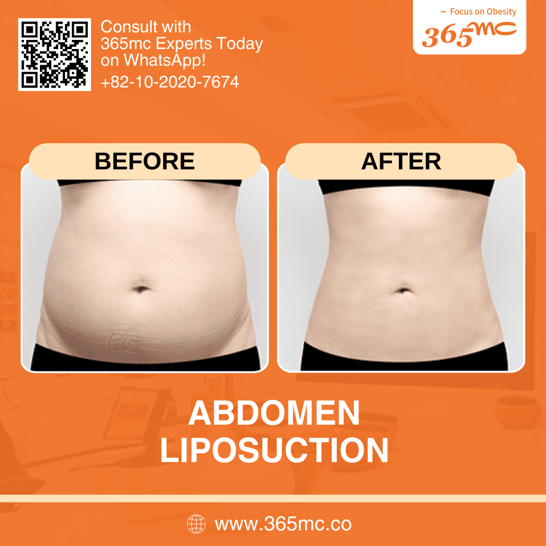 bna-abdomen-iiposuction.png