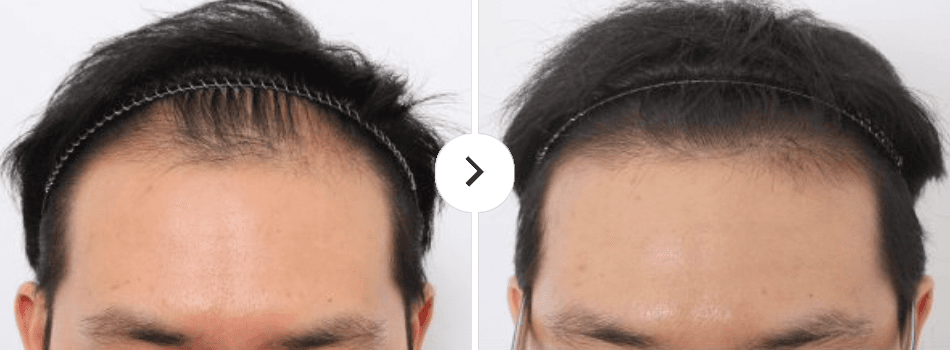 Hairline Lowering before and after