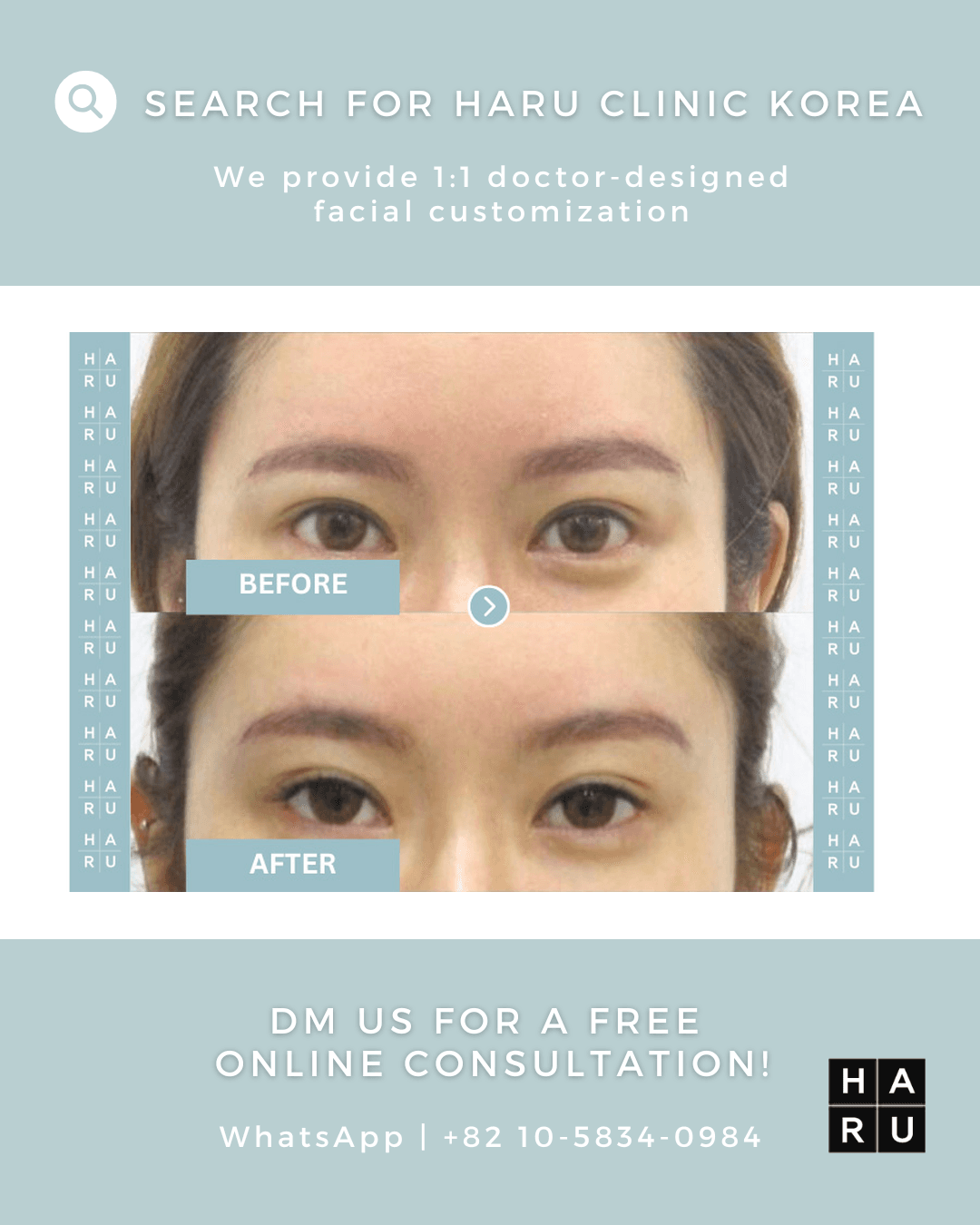Forehead Thread Lift, Eye Thread Lift